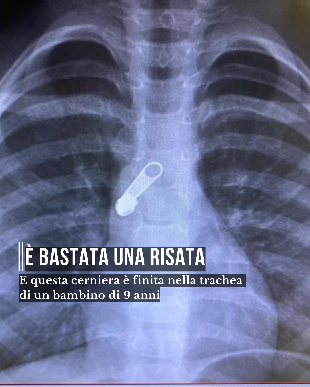 è bastata una risata. E questa cerniera è finita nella trachea di un bimbo di 9 anni