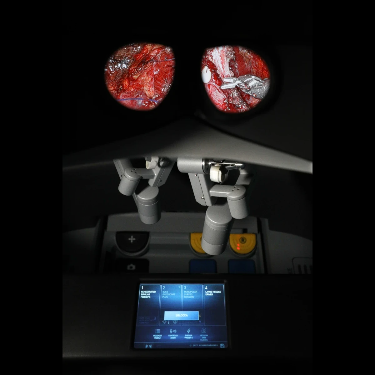 chirurgia robotica - vista dalla console