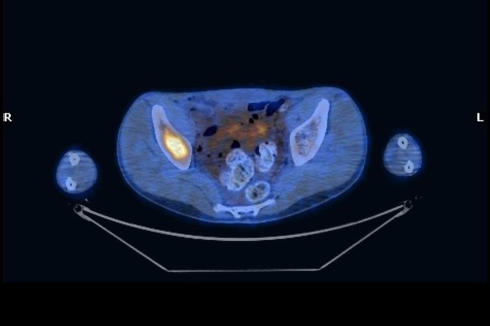 immagine di pet in cui si vede il tumore nel midollo